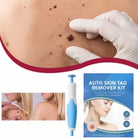 Skin tag and wart remover for body use